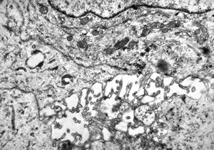 M,42y. | malignant mesothelioma - pleura